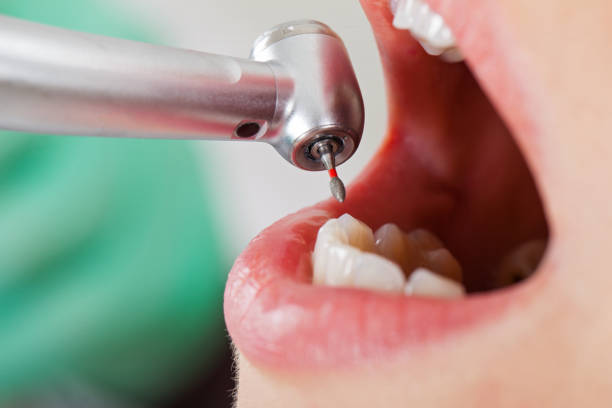 Best Emergency Wisdom Teeth Removal in Susquehanna Trails, PA